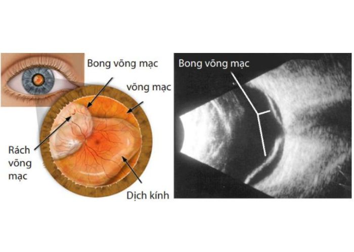 Laser quang đông võng mạc  7